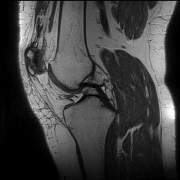 Acute-on-chronic transient lateral patellar dislocation with trochlear dysplasia (Radiopaedia 84099-99349 Sagittal PD 78).jpg