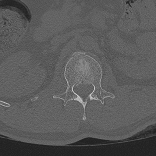 Acute L1 burst compression fracture (Radiopaedia 34430-35755 Coronal bone window 1).png