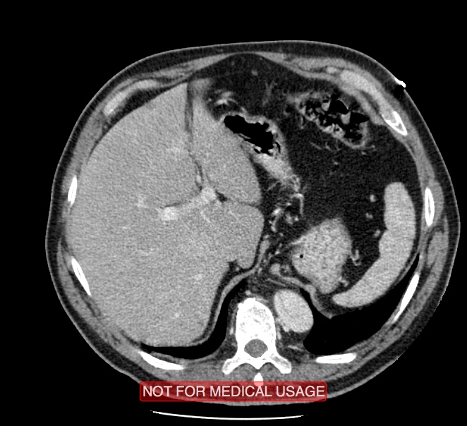Acute aortic dissection - Stanford type A (Radiopaedia 40661-43285 Axial C+ portal venous phase 64).jpg