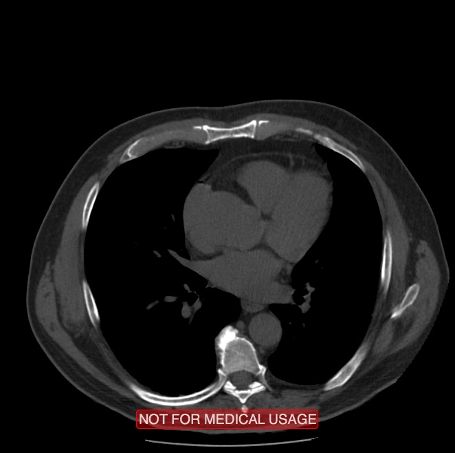 Acute aortic dissection - Stanford type A (Radiopaedia 40661-43285 Axial non-contrast 34).jpg