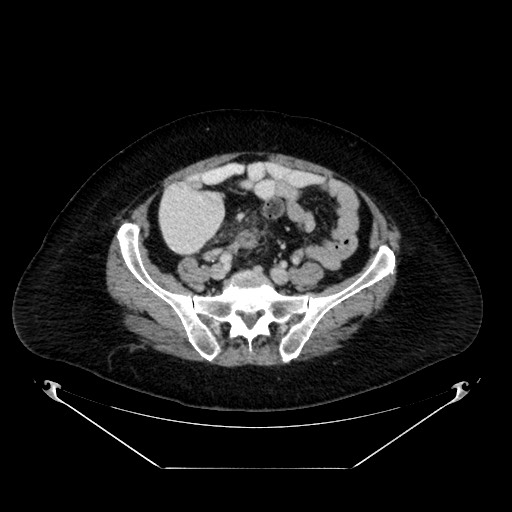 Acute appendicitis, heterotaxy syndrome (Radiopaedia 66884-76202 Axial C+ portal venous phase 92).jpg