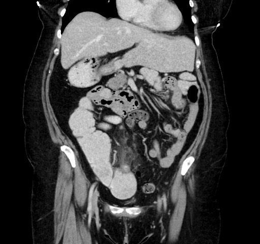 Acute appendicitis, heterotaxy syndrome (Radiopaedia 66884-76202 Coronal C+ portal venous phase 47).jpg