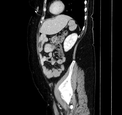 Acute appendicitis, heterotaxy syndrome (Radiopaedia 66884-76202 Sagittal C+ portal venous phase 99).jpg