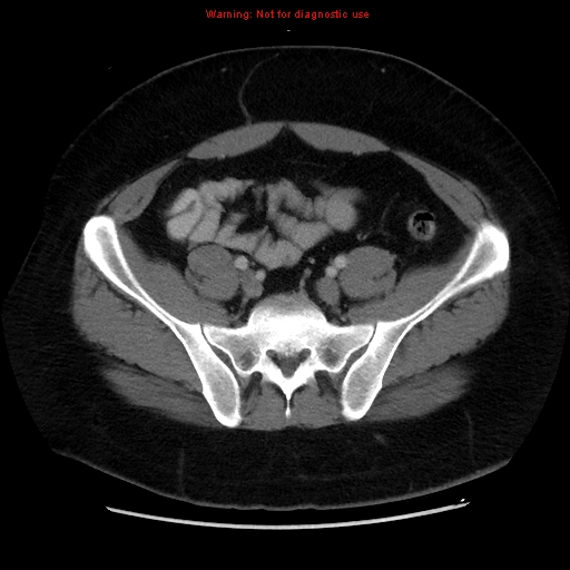 File:Acute appendicitis (Radiopaedia 12326-12607 Axial C+ portal venous phase 37).jpg