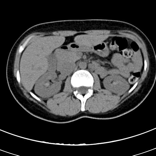 Acute appendicitis (Radiopaedia 30261-30888 Axial non-contrast 23).jpg