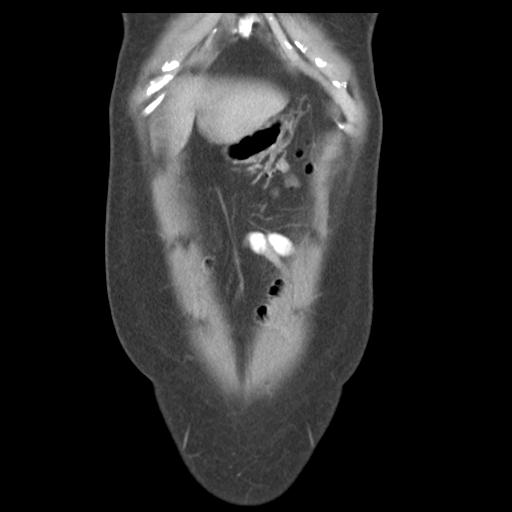 Acute appendicitis (Radiopaedia 30297-30934 Coronal C+ portal venous phase 7).jpg