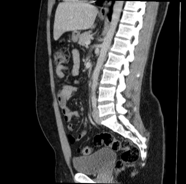 Acute appendicitis (Radiopaedia 38255-40270 Sagittal C+ portal venous phase 45).jpg