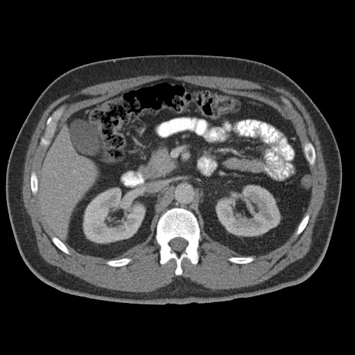 Acute appendicitis (Radiopaedia 48511-53463 Axial C+ portal venous phase 37).jpg