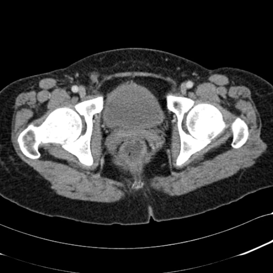 File:Acute appendicitis (Radiopaedia 48792-53822 Axial C+ portal venous phase 115).jpg
