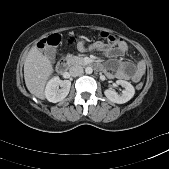 Acute appendicitis (Radiopaedia 48792-53822 Axial C+ portal venous phase 45).jpg
