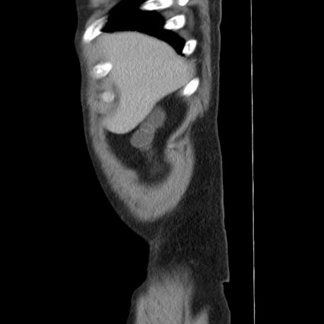 File:Acute appendicitis (Radiopaedia 66513-75790 Sagittal C+ portal venous phase 5).jpg