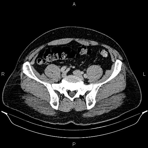 Acute appendicitis (Radiopaedia 84780-100240 Axial C+ portal venous phase 80).jpg
