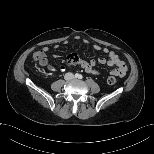 Acute appendicitis - large appendicoliths (Radiopaedia 61805-69820 Axial C+ portal venous phase 79).jpg