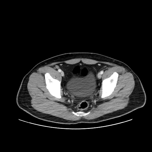 Acute appendicitis and COVID 19 pneumonia (Radiopaedia 76604-88380 Axial C+ portal venous phase 75).jpg