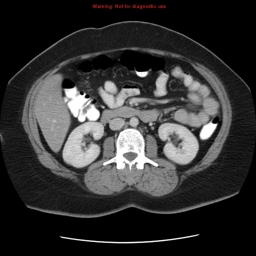 Acute appendicitis complicated by ovarian vein thrombophlebitis (Radiopaedia 16172-15851 Axial C+ portal venous phase 43).jpg