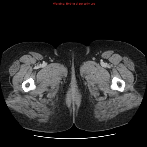 Acute appendicitis complicated by ovarian vein thrombophlebitis (Radiopaedia 16172-15851 Axial C+ portal venous phase 96).jpg