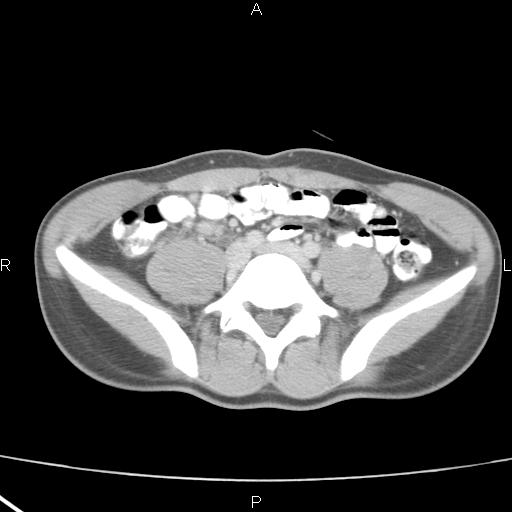 File:Acute appendicitis with CT arrowhead sign (Radiopaedia 21474-21411 Axial C+ portal venous phase 26).jpg