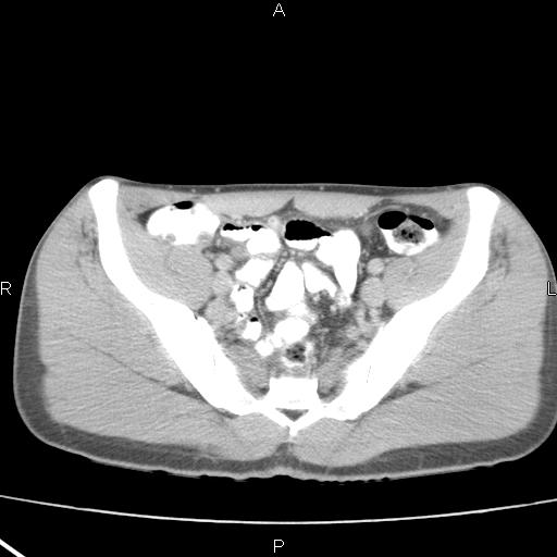 File:Acute appendicitis with CT arrowhead sign (Radiopaedia 21474-21411 Axial C+ portal venous phase 32).jpg