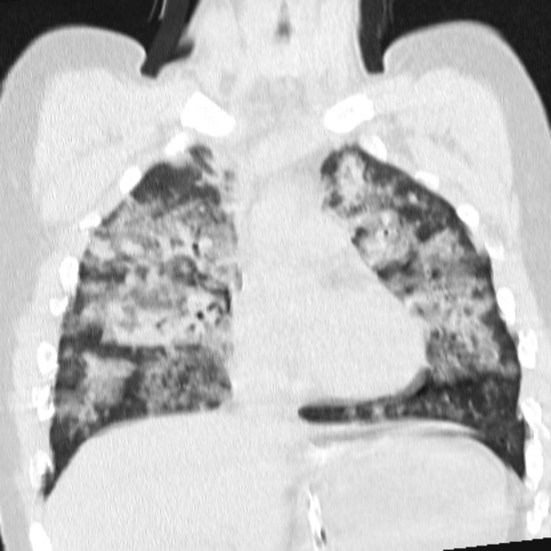 Acute aspiration pneumonitis (Radiopaedia 33605-34703 Coronal lung window 37).jpg