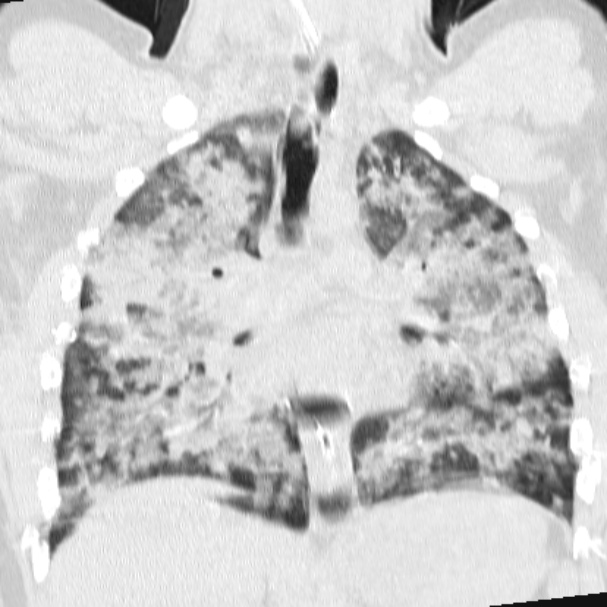 Acute aspiration pneumonitis (Radiopaedia 33605-34703 Coronal lung window 45).jpg