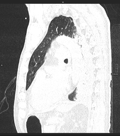 Acute aspiration pneumonitis (Radiopaedia 55642-62166 Sagittal lung window 54).jpg