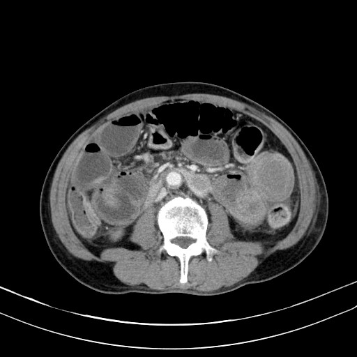 Acute bowel ischemia (Radiopaedia 87695-104114 Axial C+ portal venous phase 44).jpg