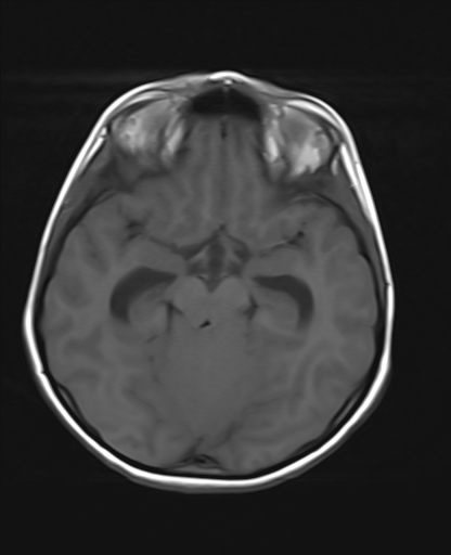 File:Acute cerebellar ataxia (Radiopaedia 61487-69446 Axial T1 9).jpg