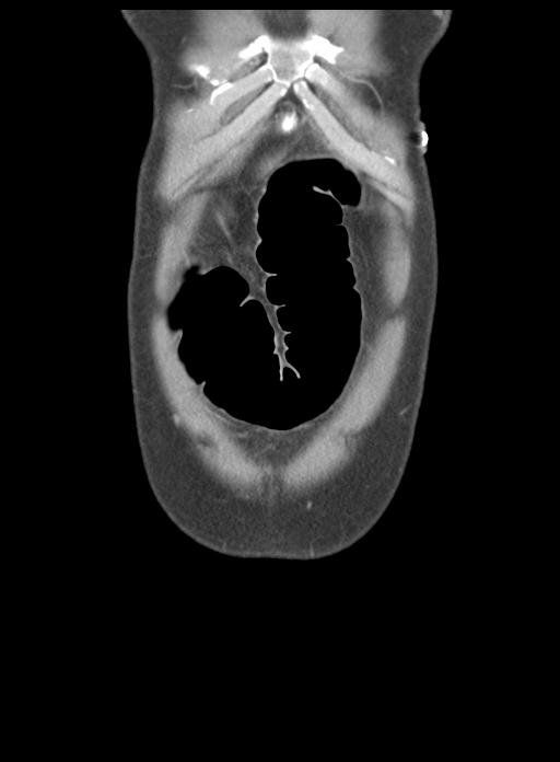 Acute cholecystitis (Radiopaedia 29814-30327 Coronal C+ portal venous phase 7).jpg