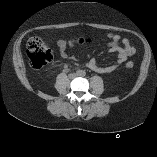 Acute cholecystitis and ureteric colic (Radiopaedia 42330-45444 Axial prone 60).jpg