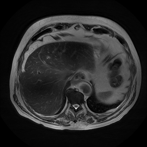 File:Acute cholecystitis complicated by pylephlebitis (Radiopaedia 65782-74915 Axial T2 8).jpg