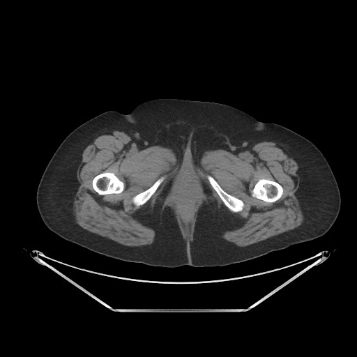 File:Acute cholecystitis with tensile fundus sign (Radiopaedia 71394-81723 Axial non-contrast 130).jpg