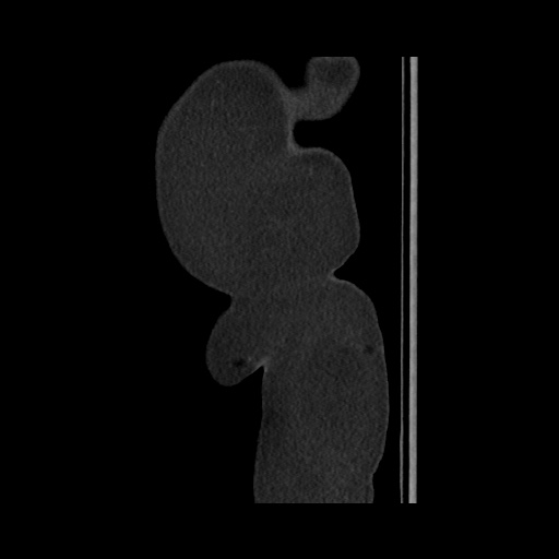 File:Acute cholecystitis with tensile fundus sign (Radiopaedia 71394-81723 Sagittal non-contrast 165).jpg