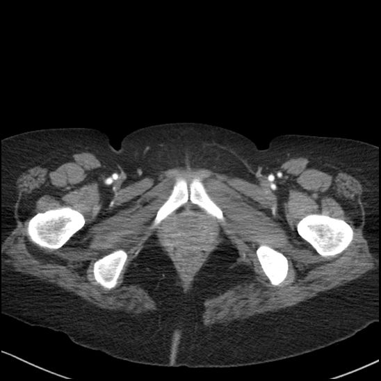 Acute colonic hemorrhage in ulcerative colitis (Radiopaedia 77415-89538 Axial C+ arterial phase 140).jpg