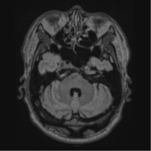 Acute disseminated encephalomyelitis (ADEM)- Anti-NMDA receptor encephalitis (Radiopaedia 54920-61201 Axial FLAIR 16).png