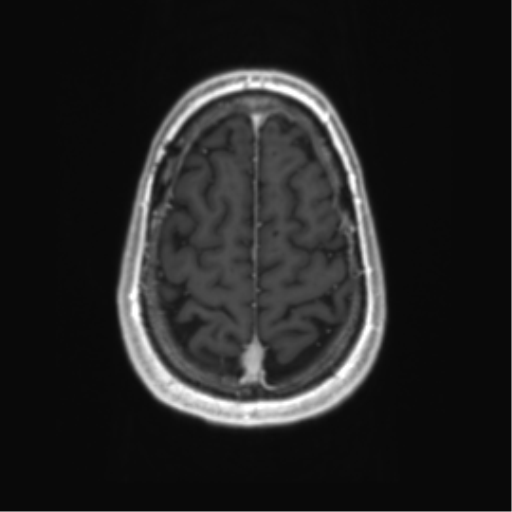 Acute disseminated encephalomyelitis (ADEM) (Radiopaedia 65319-74350 Axial T1 C+ 56).png