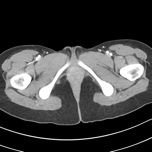 Acute gangrenous appendicitis with perforation (Radiopaedia 40152-42662 Axial C+ portal venous phase 81).png