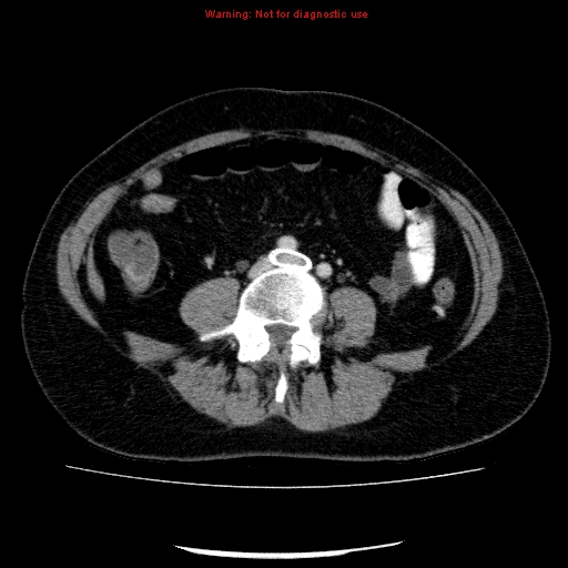 Acute gangrenous cholecystitis (Radiopaedia 10123-10661 Axial C+ portal venous phase 66).jpg