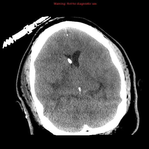 File:Acute hemorrhagic leukoencephalitis (Radiopaedia 14076-72275 Axial non-contrast 18).jpg