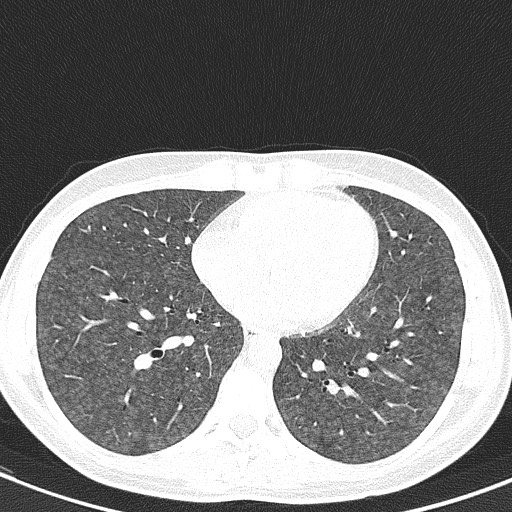 File:Acute hypersensitivity pneumonitis (Radiopaedia 85293-100870 Axial lung window 79).jpg