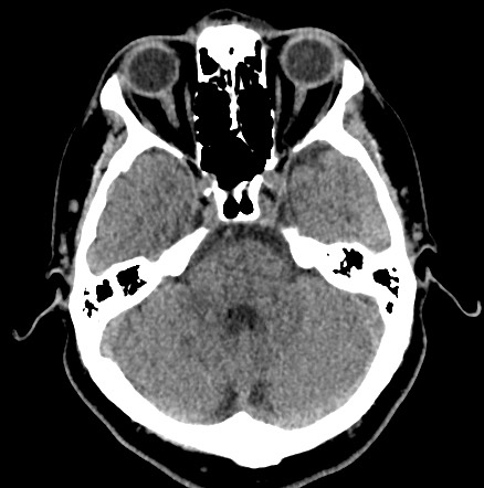 File:Acute internal carotid artery dissection (Radiopaedia 53541-59558 Axial non-contrast 17).jpg