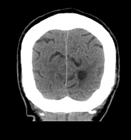Acute left anterior cerebral artery territory infarction (Radiopaedia 51785-57578 Coronal non-contrast 52).jpg