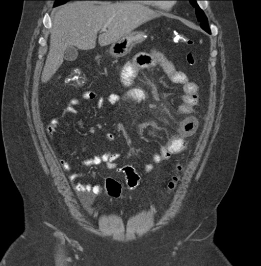 Acute mesenteric venous ischemia (Radiopaedia 46041-50383 Coronal C+ portal venous phase 30).jpg