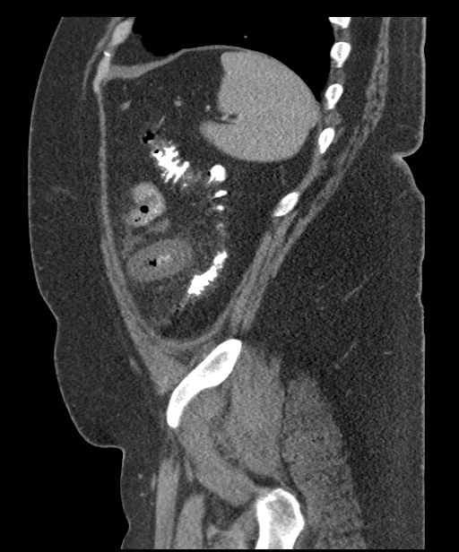 Acute mesenteric venous ischemia (Radiopaedia 46041-50383 Sagittal C+ portal venous phase 99).jpg