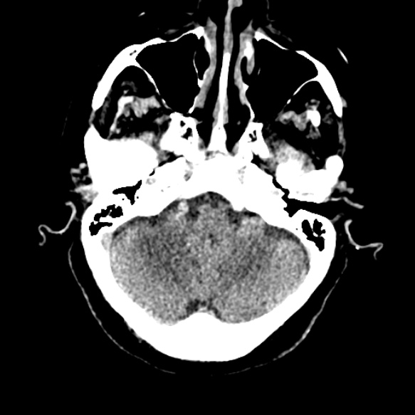 Acute middle cerebral artery territory infarct (Radiopaedia 52380-58283 Axial non-contrast 17).jpg