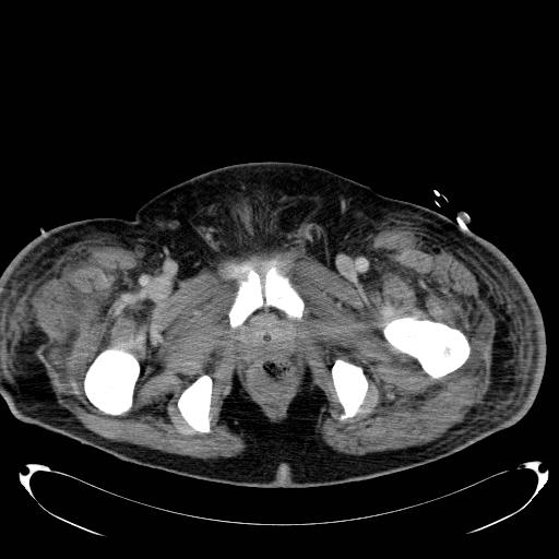 Acute pancreatic necrosis (Radiopaedia 13560-18503 Axial C+ portal venous phase 86).jpg