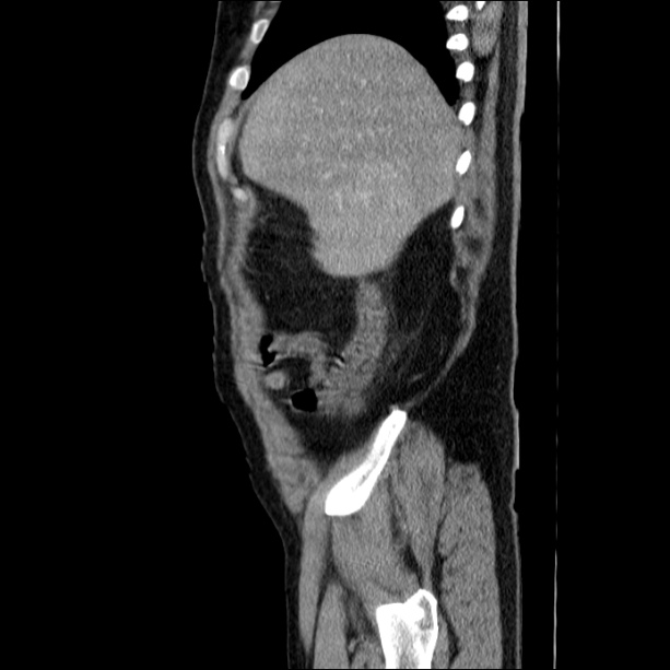 Acute pancreatitis (Radiopaedia 26663-26813 Sagittal C+ portal venous phase 13).jpg