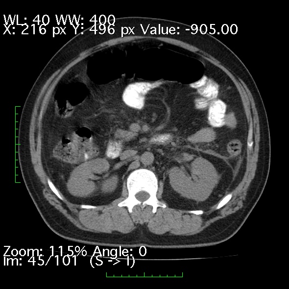 Acute pancreatitis (Radiopaedia 34043-35276 Axial non-contrast 45).jpg