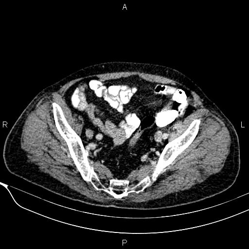 Acute pancreatitis (Radiopaedia 85146-100701 Axial C+ portal venous phase 54).jpg