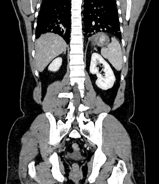 File:Acute pancreatitis (Radiopaedia 87428-103757 Coronal C+ portal venous phase 68).jpg