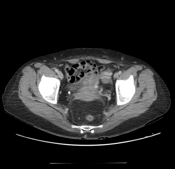 Acute pancreatitis - Balthazar E - post ERCP (Radiopaedia 27562-27772 Axial C+ portal venous phase 69).png